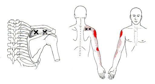 Triggerpoint schouder