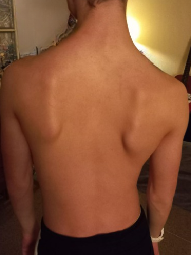 Rug voor NKT behandeling